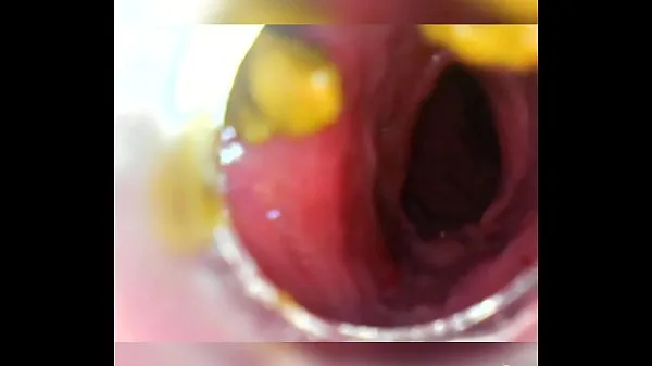 Εμφάνιση κλιπ μονάδας δίσκου Endoscope withdraw after deep insertion