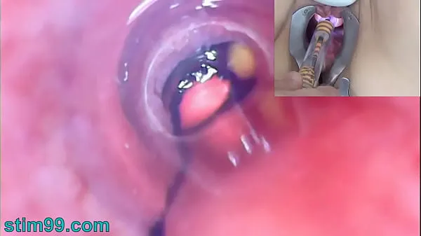 Show Mature Woman Peehole Endoscope Camera in Bladder with Balls drive Clips